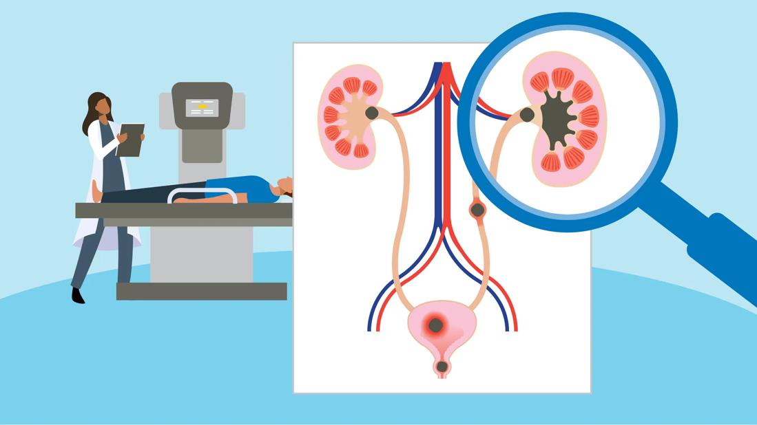 Closeup of kidney stones blocking pathways for urine with doctor and patient in background in radiology