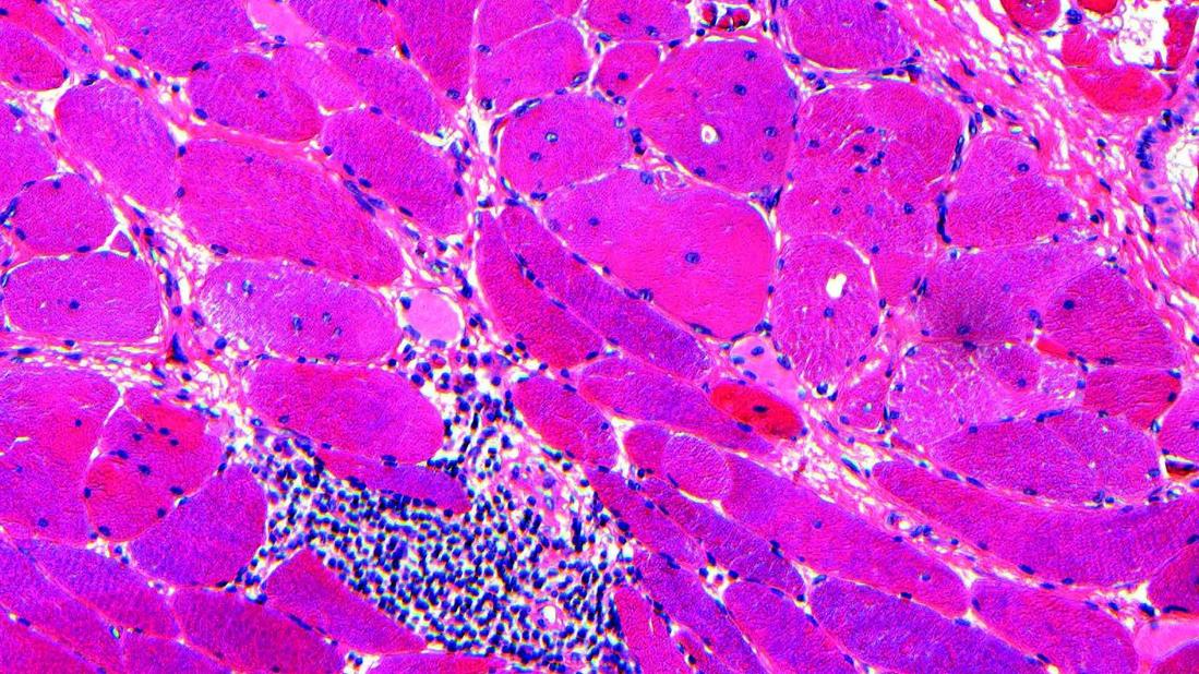 Myositis