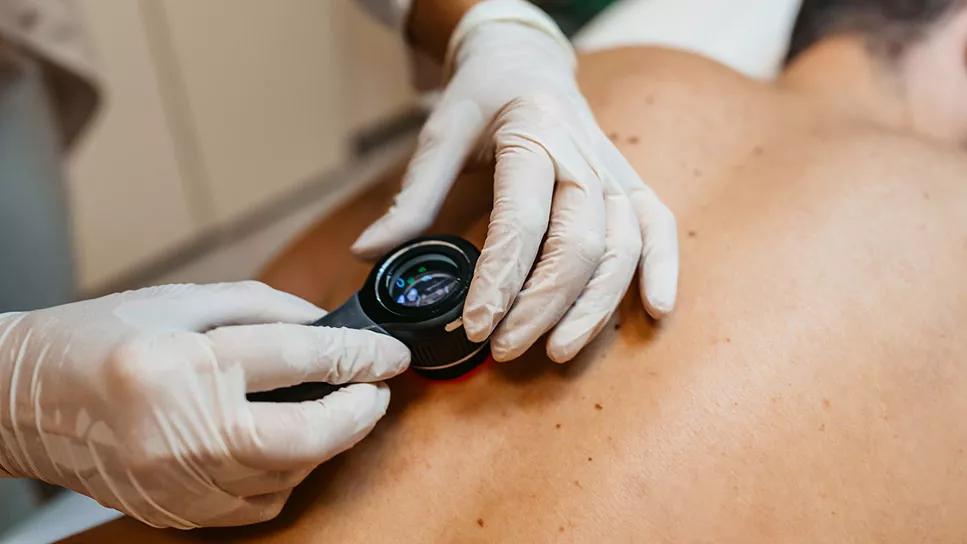 Squamous cell skin cancer