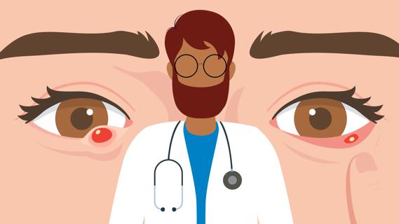 Eye doctor in front of oversized in face, with a chalazion on one eye and a stye on the other