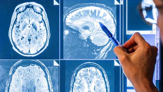 hand pointing at brain scans on a computer monitoring